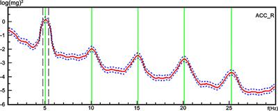 The Characteristics of Tremor Motion Help Identify Parkinson's Disease and Multiple System Atrophy